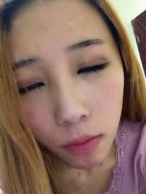 花了点眼影和眼线遮住淤青,画得不满意.感觉等眼睛恢复了.