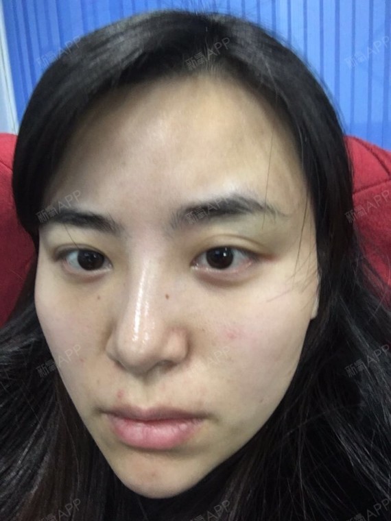 不作不会死玻尿酸垫下巴第9天美丽日记-新氧美