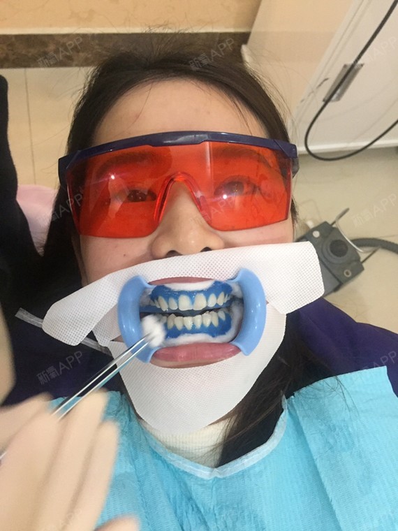 有谁做过冷光美白吗?最好杭州的,想问点问题,求帮助