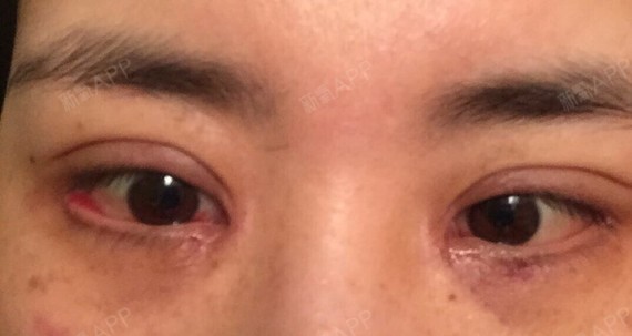 左眼睑外翻严重,睑球完全分离,在术后第一天医生给我修复过一次,情况