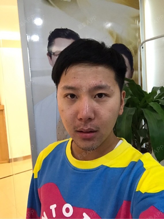 Jason小丁红蓝光祛痘第5天美丽日记-新氧美容