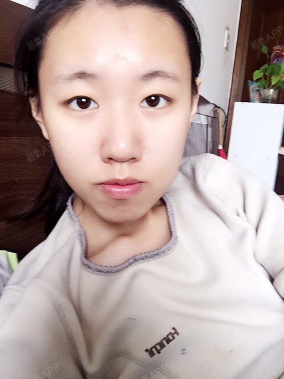 是该肉毒素缩鼻头还是硅胶隆鼻_圈子-新氧美容整形