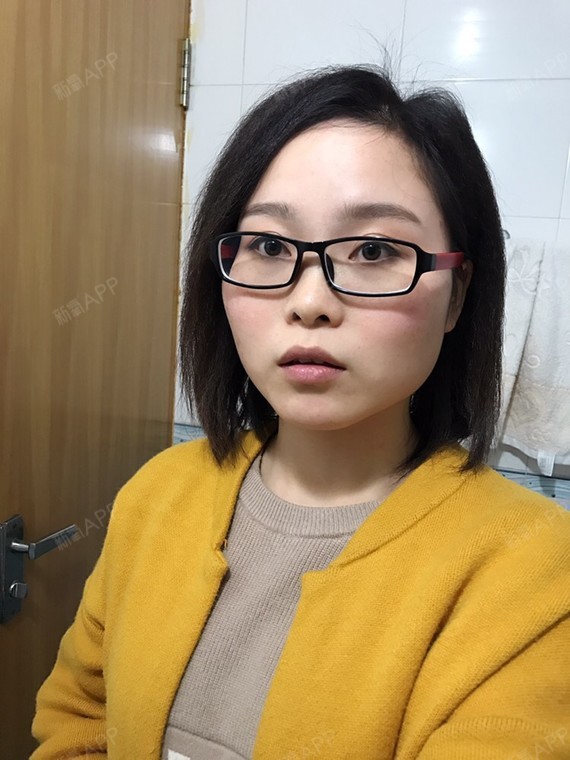 不笑的时候面部扁平,希望通过脂肪填充,填补凹陷处,_圈子-新氧美容