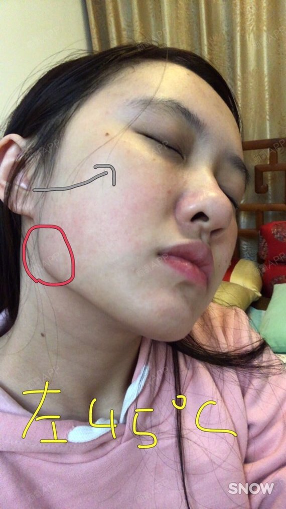 这张可以看出下颚角很明显比较方,并且可以看出楼主脸的侧面面积很大