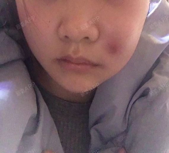 脸颊两侧打了法令纹.少那边吸收了.多的那边发炎你然