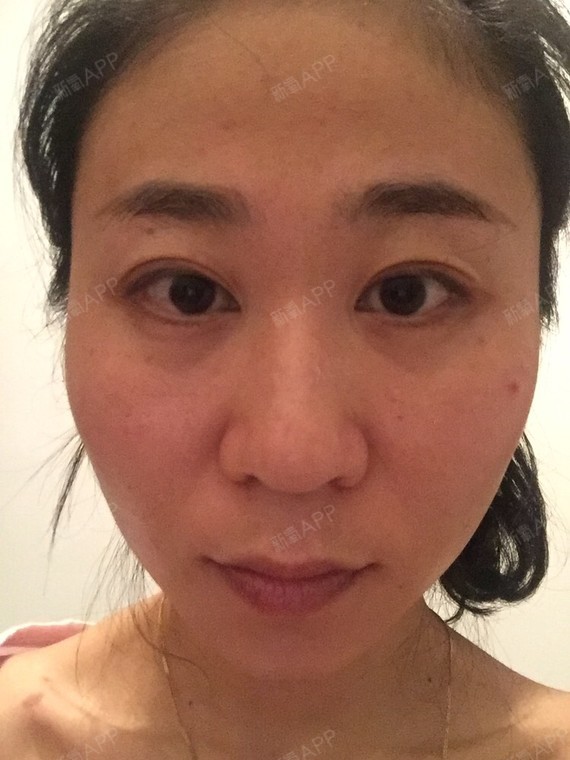 下颌角骨头太宽,显的脸很大,求救