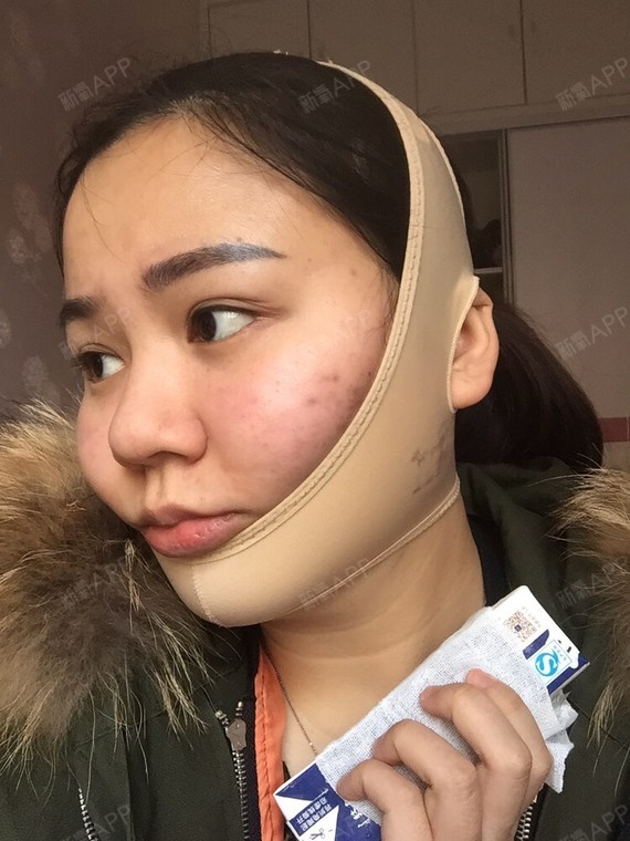 取颊脂垫瘦脸好不好_效果图_mascot取颊脂垫瘦脸术后2