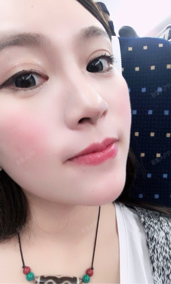 初壹乳头美丽日记-新氧美容整形长和女生完善啊岁姑娘才乳头几图片