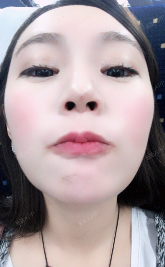 初壹日记美丽高原-新氧美容整形泽军男生女生上任姑娘图片