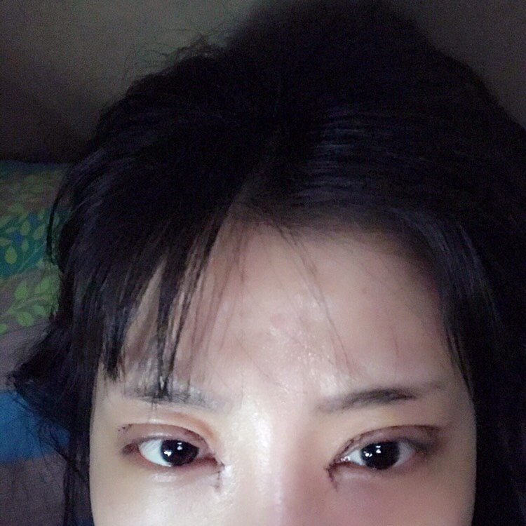 持续消肿期开内眼角第8天 · 第1篇日记