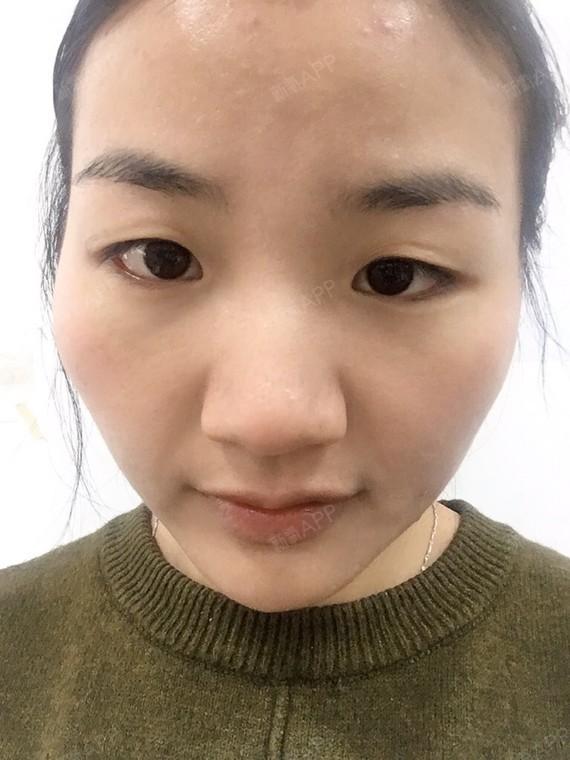 内双,眼皮脂肪厚.且上眼皮有点下移遮眼,双眼皮贴几乎粘不住.