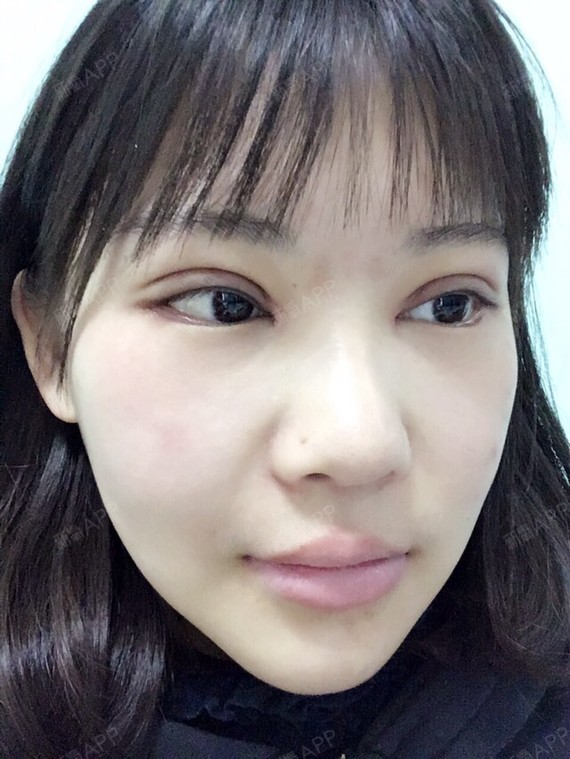 下眼下至术