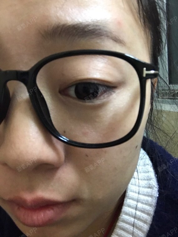 我是金鱼眼很凸眉毛跟眼睛距离也很大不戴眼镜很丑然后平视基本是单的向下看才_圈子-新氧美容整形