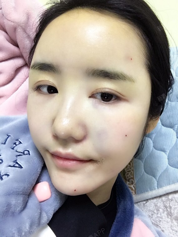 自体脂肪填充全脸