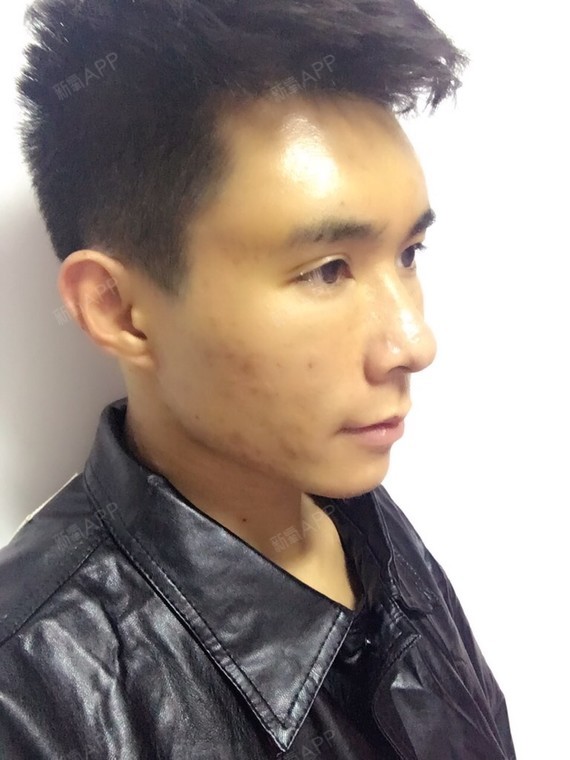 自体脂肪丰额头好不好_效果图_傲仔_720517自体脂肪丰