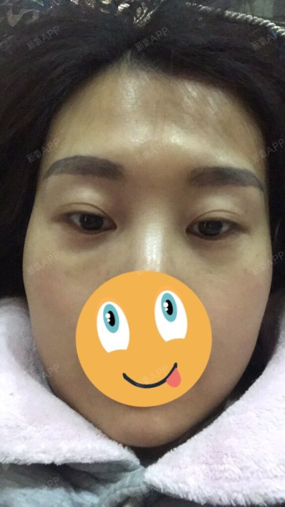 稍微有点肿,针眼几乎看不到了,因为一支填充眉心还有剩余,医生就给我