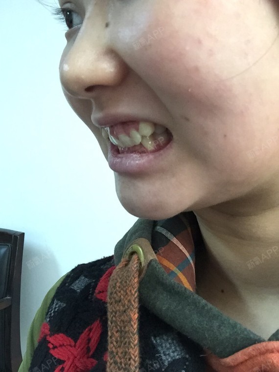牙齿内倾深覆合以前还好最近吃东西的时候老是咬到下嘴唇内壁的肉脸不