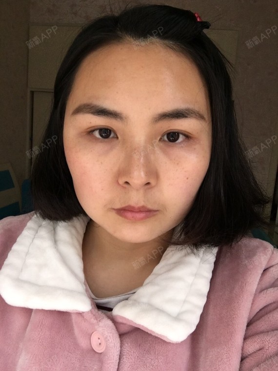 黑眼圈和泪沟一直是我的困扰,还有颧骨高,较大,想变小,轮廓流畅.