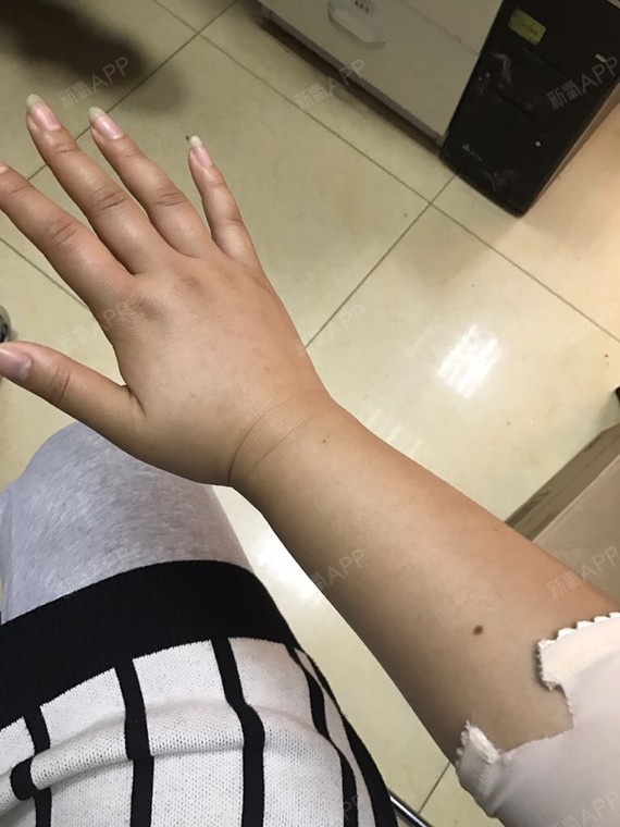 笑笑吸脂丽日瘦瘦脸第3天美腹部记-新氧美容整形小丫针前需要v吸脂什么图片