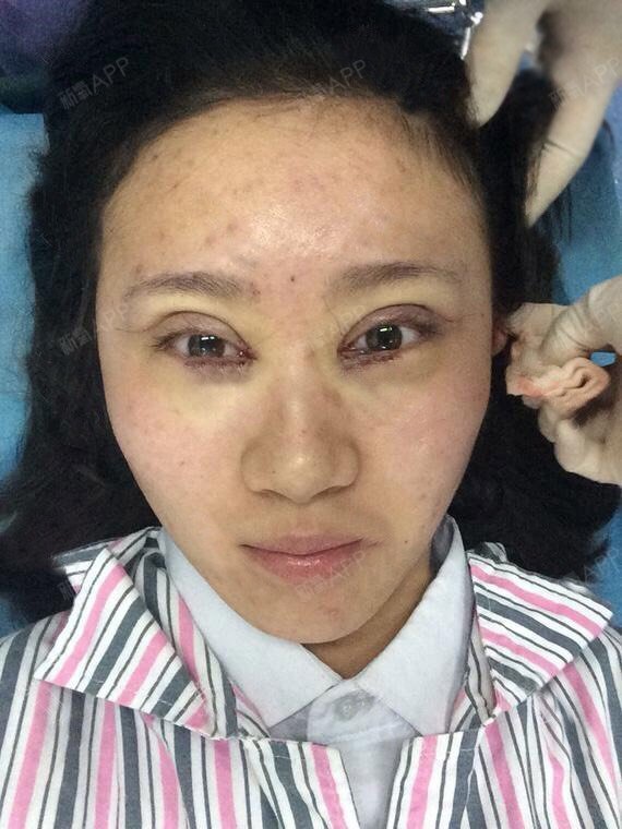做双眼皮这事儿,我其实"预谋"了很久很久,算起来有个四五年了吧.