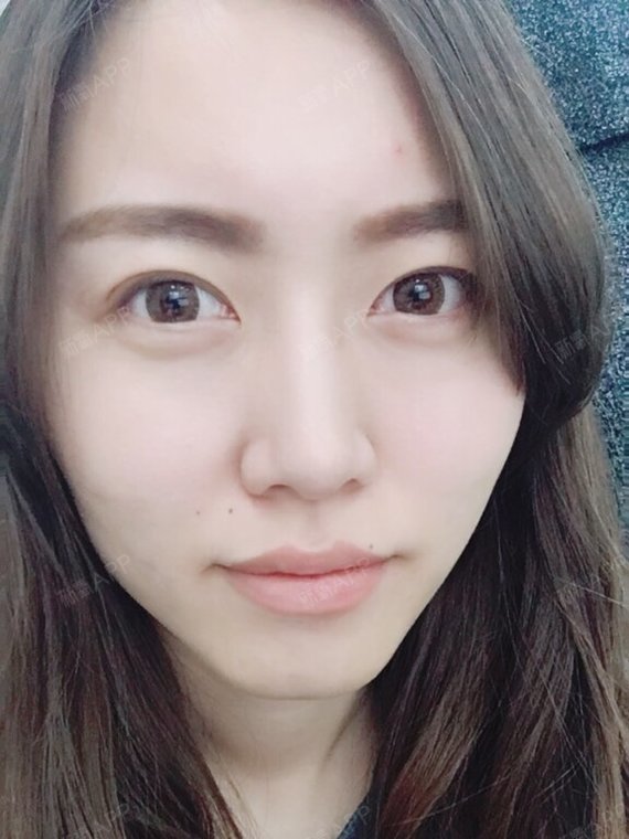埋线双眼皮好不好_效果图_氧气qttef06埋线双眼皮术后