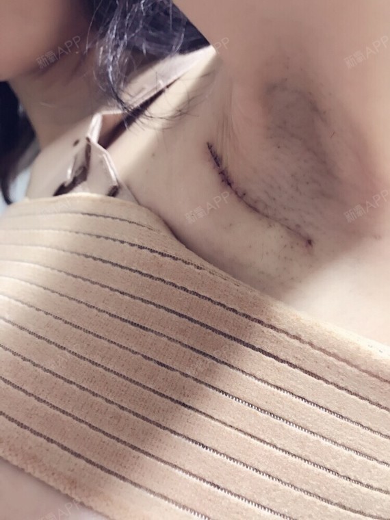 新氧- 木木木木夕 | 胸部 | 隆胸 | 假体隆胸 | 术后当自强 | 上海