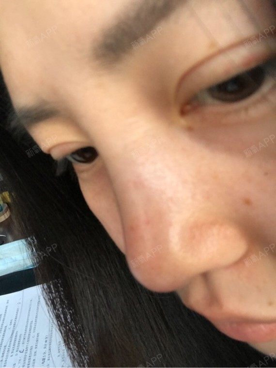 耳软骨垫鼻尖,鼻头红肿,不疼不痒.有什么问题吗