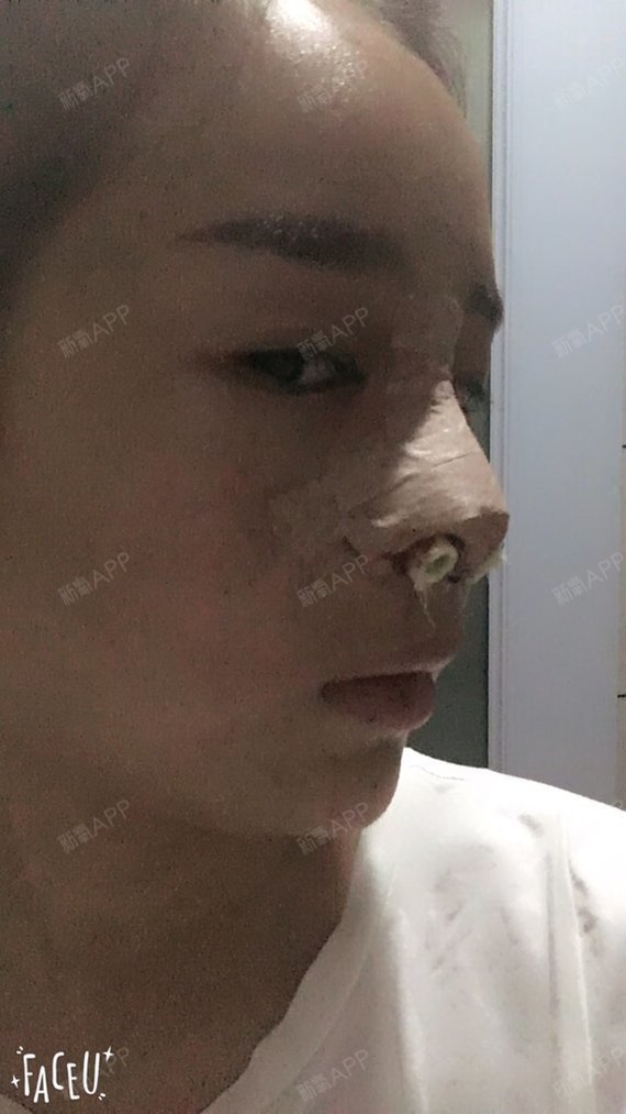 泰民爱水晶耳软骨复合隆鼻第1天美丽日记-新氧