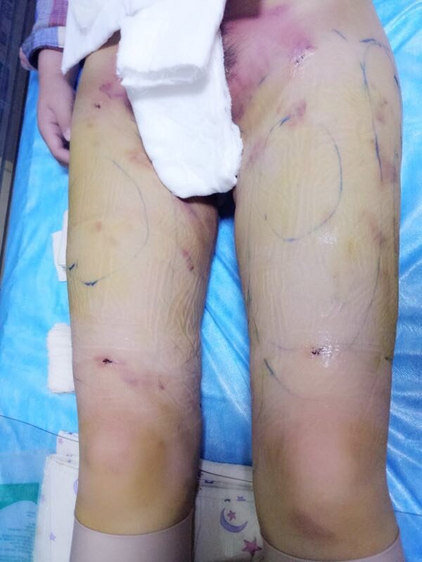 杭州王圣林医疗美容诊所吸脂瘦大腿怎么样?_崽崽妈妈
