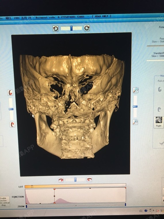 刚出炉的ct,适合下颌角吗