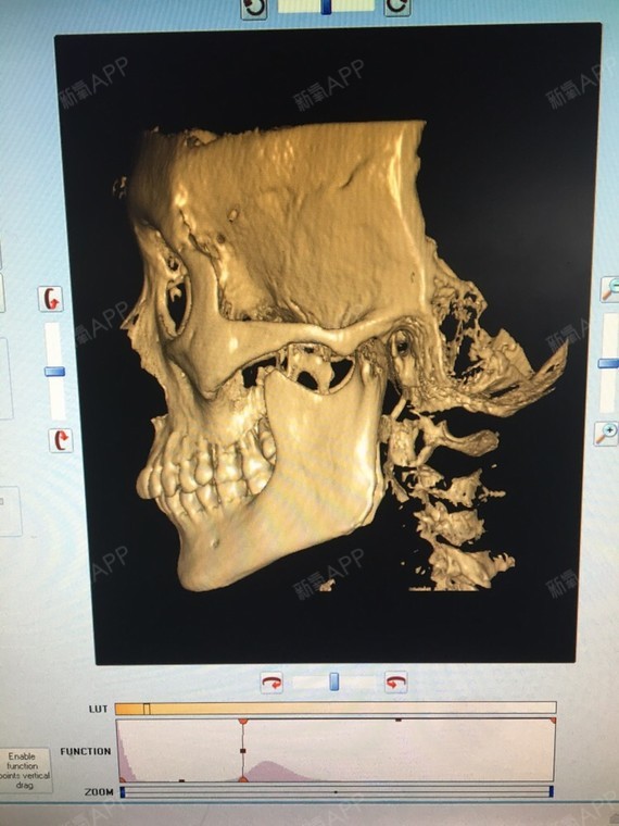 刚出炉的ct,适合下颌角吗