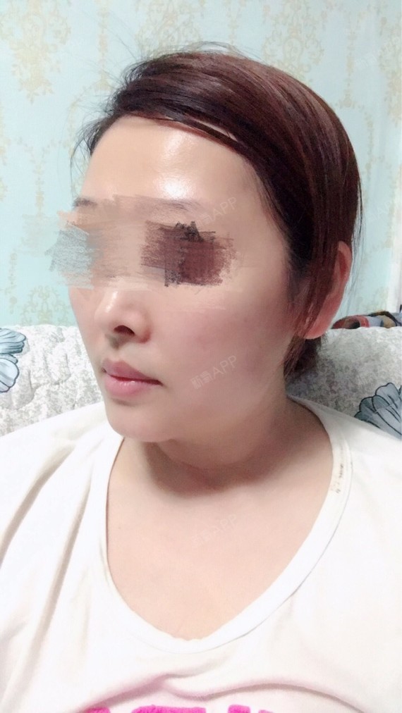 夏天_362040光纤溶脂瘦脸第0天美丽日记-新氧