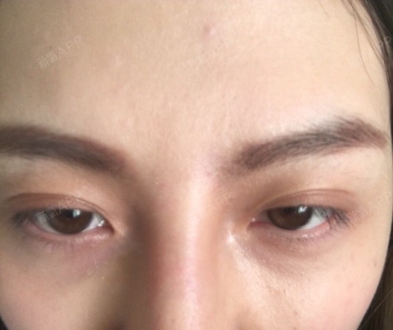 纳米无痕两年了 两只眼睛不对称 有三层眼皮 这种双眼皮是失败