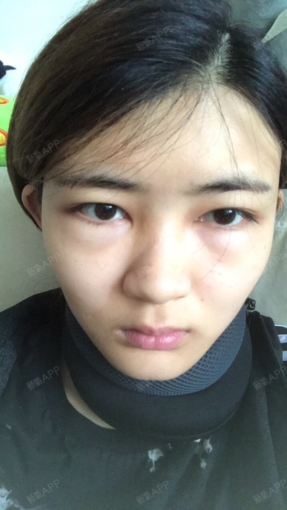 5月22号在成都艾尚柏雅做完自体脂肪填充.花了