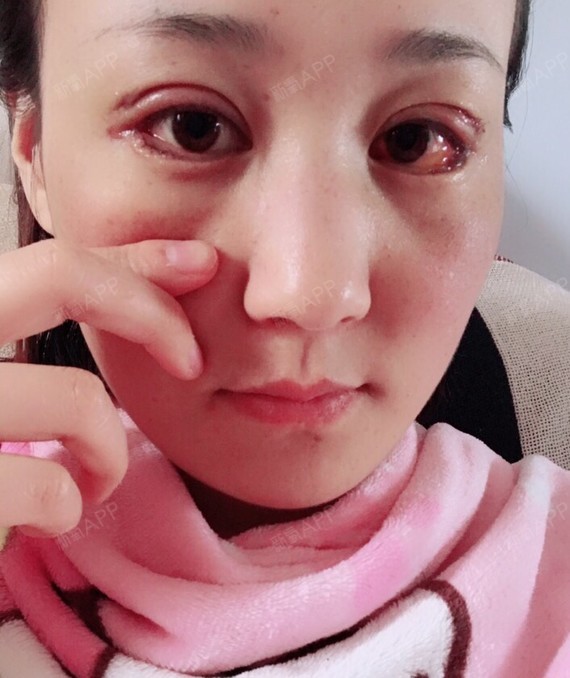 术后第五天,明天就可以拆线啦…看其他姐妹说拆线很