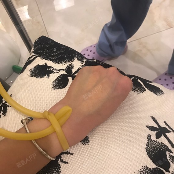 一会打完针我想再问问大夫关于脸部的问题,总觉得自己肉嘟嘟婴儿肥有
