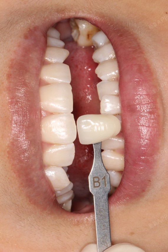 新氧- 颖颖颖颖y | 美容美妆 | 牙齿 | 牙齿美容 | 冷光美白 | 术后当