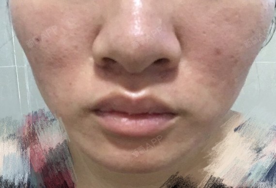 做完点阵激光,然后冷喷了,同时又拿冰袋敷了很