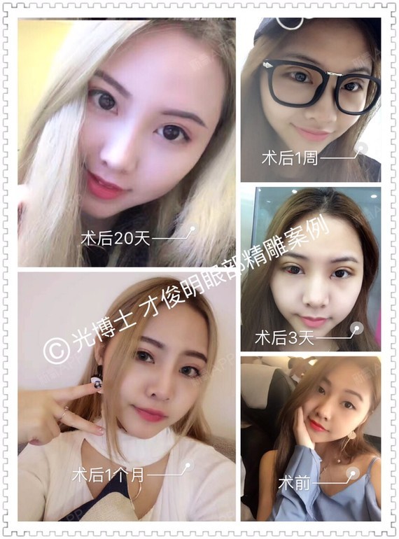 双眼皮案例分享术前求美者轻微肿眼泡,眼皮沉重感较强