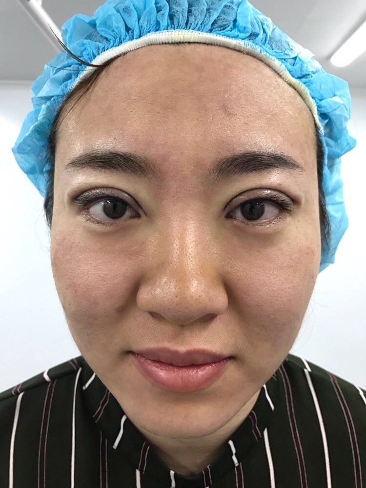 埋线双眼皮第23天