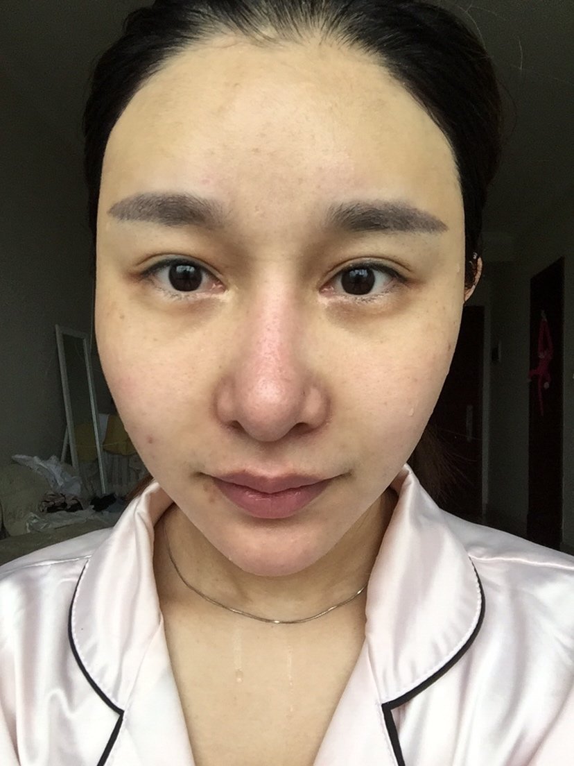 需要手术的理由:之前做过鼻综合,现在鼻头肥大,很不自然,想要那种韩式