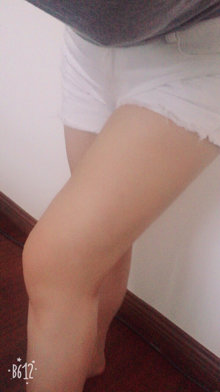 吸脂瘦大腿第40天