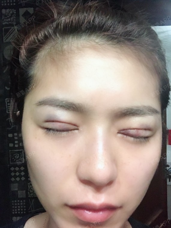 joyee0929埋线双眼皮第0天美丽日记