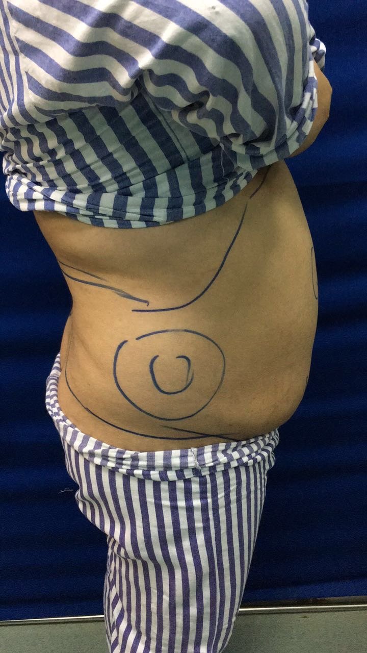 888888888888的美丽日记"6.3"吸脂瘦腹部