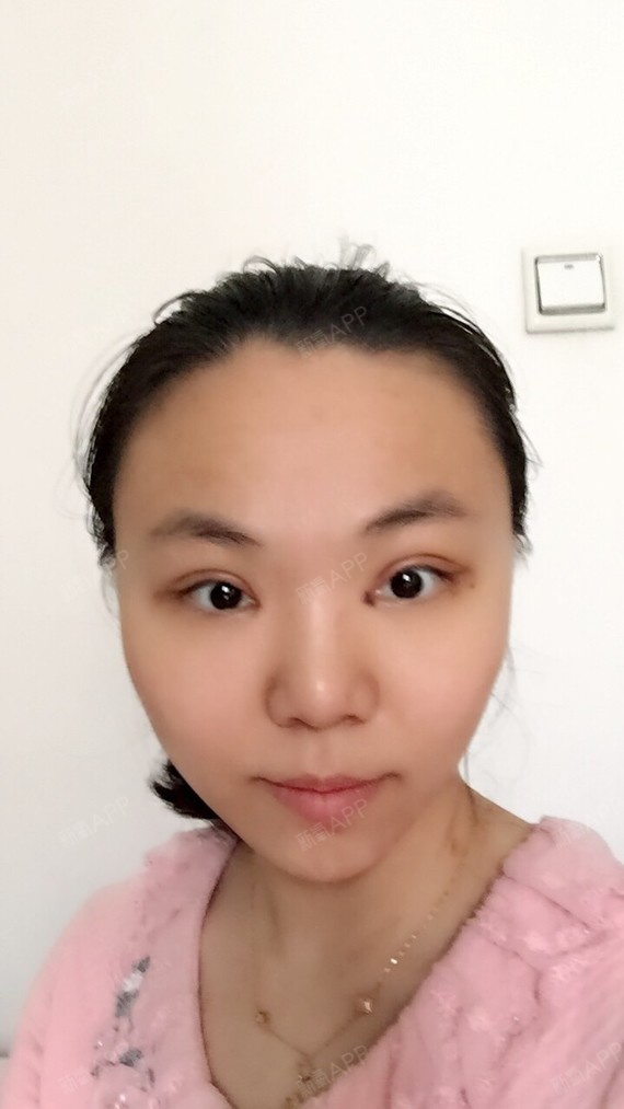 昨天手残擦拭伤口的时候擦眼角擦狠了,今天就紫了,希望不要留