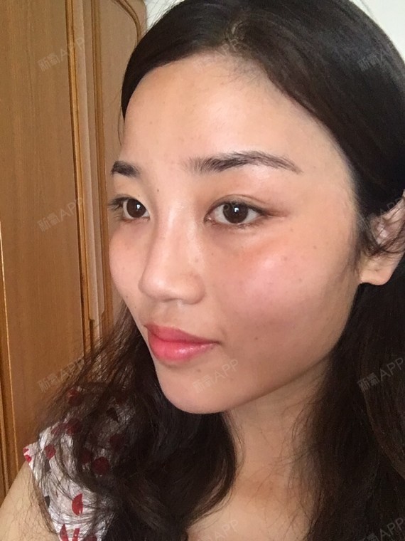 鼻部多项  需要手术理由:从小塌鼻子,脸太平还被人起外号叫甜烧饼