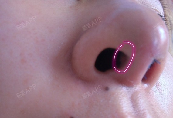 假体隆鼻左侧鼻孔有红色凸起