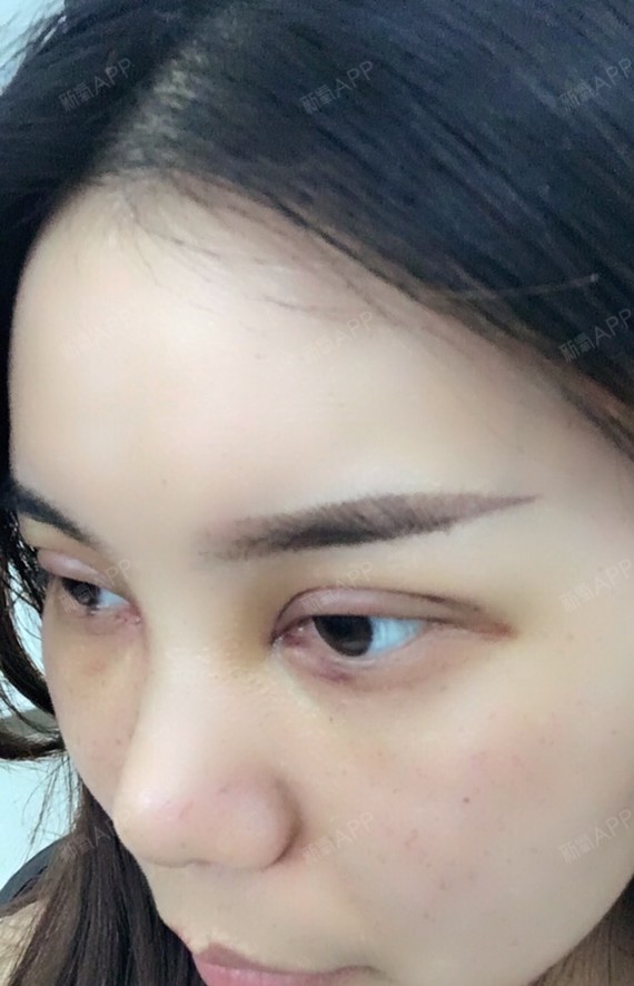 新氧 思美人 眼部 开眼角 双眼皮 开内眼角 切开双眼皮