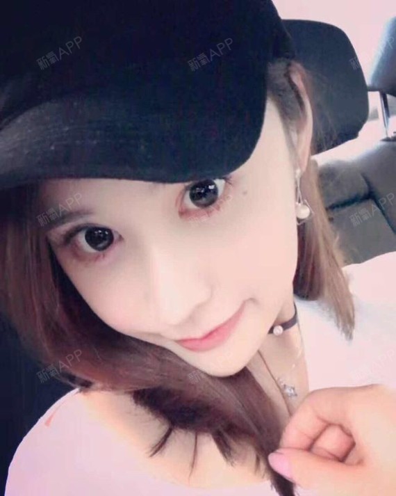 下巴截骨术好不好_效果图_小zz大酱紫下巴截骨术术后第143天_新氧美容