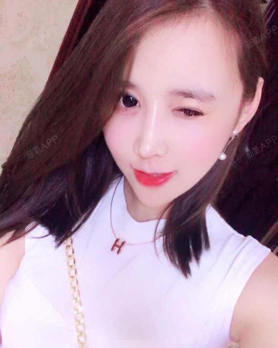 下巴截骨术好不好_效果图_小zz大酱紫下巴截骨术术后第143天_新氧美容